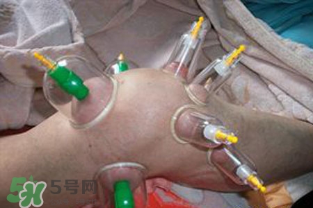小腿能拔罐嗎？在小腿上拔火罐有什么作用？