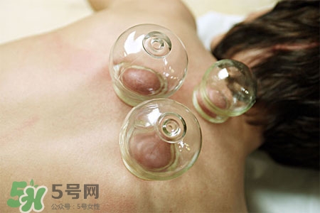 拔罐分季節(jié)嗎？不同季節(jié)的拔罐禁忌