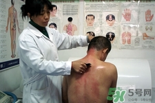 刮痧可以減肥嗎？刮痧減肥有效果嗎？