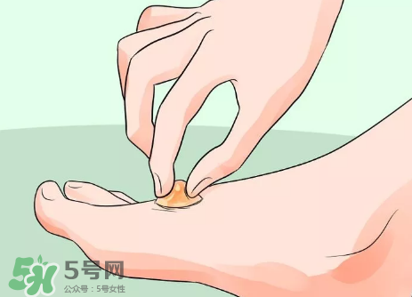 水泡怎么處理？水泡要不要刺破？