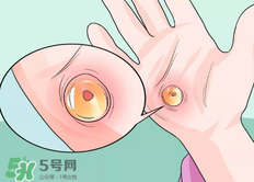 水泡怎么處理？水泡要不要刺破？