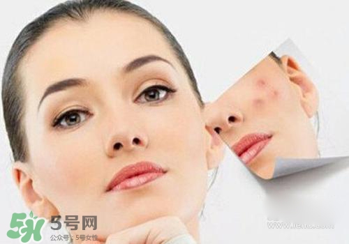 封閉性粉刺會自己消失嗎？封閉性粉刺好了會留疤嗎？