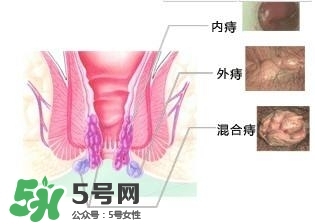 痔瘡吃什么藥效果好？痔瘡吃什么藥好得快？
