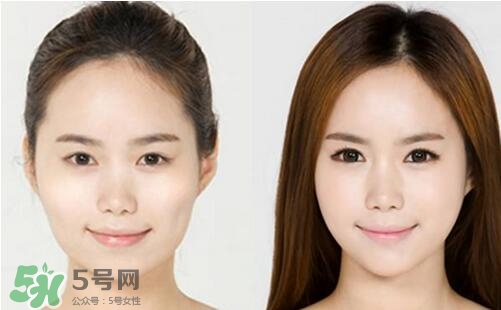瘦臉針分為幾種類型？瘦臉針有哪幾個牌子？