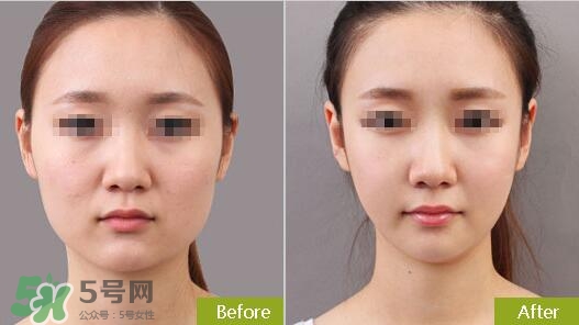 瘦臉針分為幾種類型？瘦臉針有哪幾個牌子？