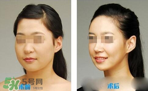 瘦臉針分為幾種類型？瘦臉針有哪幾個牌子？