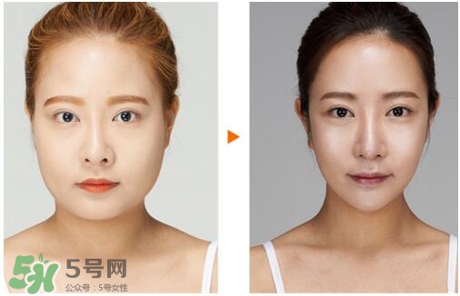 瘦臉針分為幾種類型？瘦臉針有哪幾個牌子？