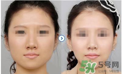 打瘦臉針疼不疼？打瘦臉針的注意事項(xiàng)