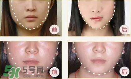 打完瘦臉針多久可以化妝？打完瘦臉針的反應