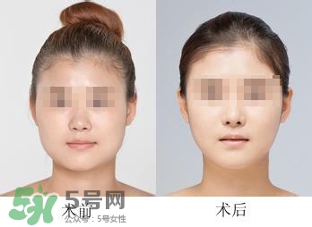 打瘦臉針能喝酒嗎？打瘦臉針能吃海鮮嗎？