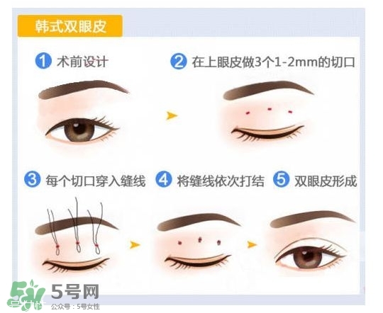 割雙眼皮有幾種做法？雙眼皮有哪幾種形狀？