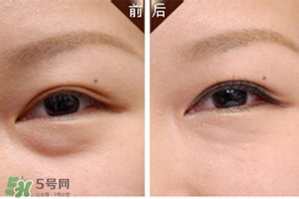 臥蠶是黑眼圈嗎？臥蠶和黑眼圈的區(qū)別