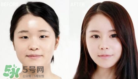 割雙眼皮有什么后遺癥嗎？割雙眼皮有什么危害性？