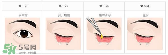 眼袋是怎么形成的？手術(shù)去眼袋安全嗎