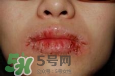 嘴唇干燥是什么原因？嘴唇干裂脫皮怎么辦？