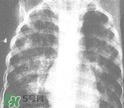 紅眼病是怎么引起的？紅眼病怎么產(chǎn)生的