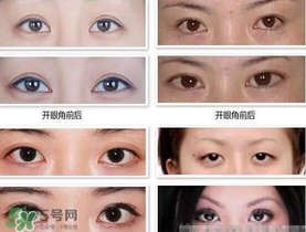 哪些人需要開眼角？需要開眼角的眼睛圖片