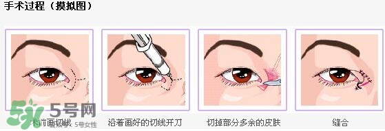 哪些人需要開眼角？需要開眼角的眼睛圖片