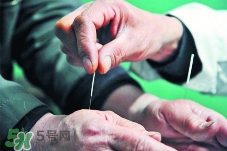 沒病可以針灸嗎？沒病可以扎針嗎？