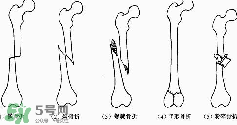 骨折吃什么好得快？骨折后注意事項(xiàng)