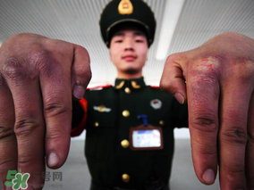 三月份還長(zhǎng)凍瘡嗎？三月份凍瘡沒好怎么辦？