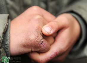 三月份還長(zhǎng)凍瘡嗎？三月份凍瘡沒好怎么辦？