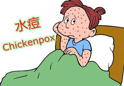 水痘是天花嗎？水痘是不是天花？