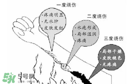 燙傷起泡要挑破嗎？燙傷起泡怎么處理？