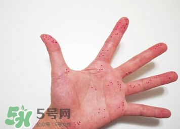 切辣椒后手很辣怎么辦？切辣椒后手很辣多久能好