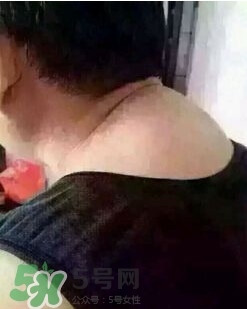 刮痧之后可以艾灸嗎？刮痧之后可不可以艾灸