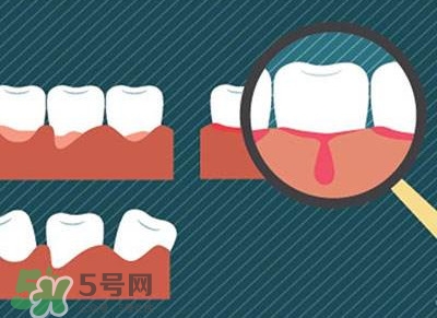 牙齦出血是什么原因？牙齦出血怎么回事