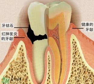 牙結(jié)石是什么？牙結(jié)石圖片
