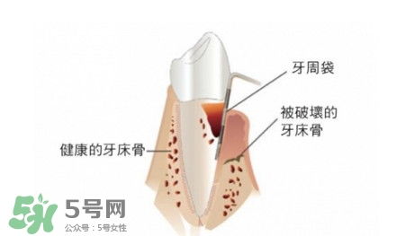 牙周炎怎么治療？牙周炎怎么治好