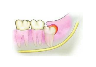 長智齒需要拔掉嗎？長了智齒一定要拔掉嗎