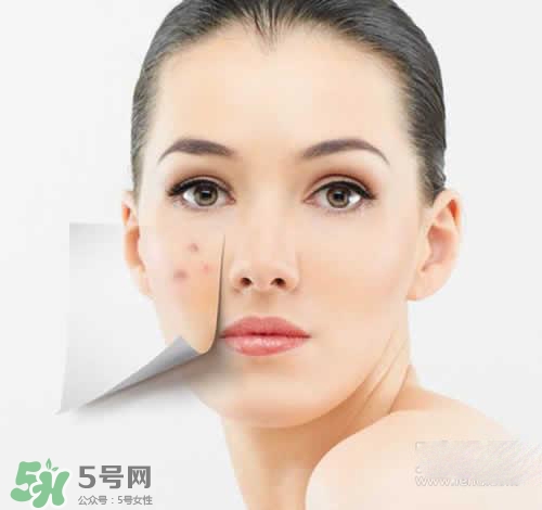 黑色痘印多久會消失？黑色痘印消失時間