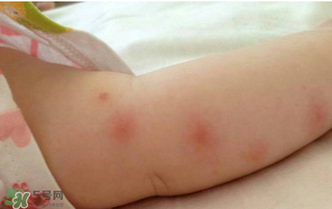 嬰兒蚊子咬了怎么消腫？嬰兒蚊子咬了怎么消腫止癢最快？