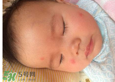 嬰兒蚊子咬了怎么消腫？嬰兒蚊子咬了怎么消腫止癢最快？