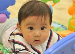 嬰兒被蚊子咬了如何去紅點(diǎn)？被蚊子咬后紅點(diǎn)如何去除？
