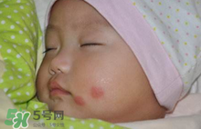 嬰兒被蚊子咬了如何去紅點(diǎn)？被蚊子咬后紅點(diǎn)如何去除？