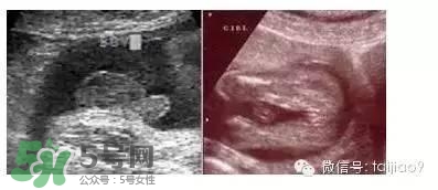 B超單數(shù)據(jù)怎么看男女？B超單看男女準(zhǔn)嗎？