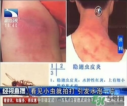 隱翅蟲有毒嗎？隱翅蟲會(huì)毀容嗎？