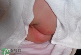 尿布疹怎么辦？寶寶尿布疹擦什么藥好？