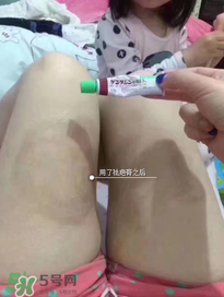 日本msd祛疤膏怎么樣？日本msd祛疤膏有用嗎？