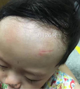 日本msd祛疤膏是抗生素嗎？日本msd祛疤膏是不是抗生素？