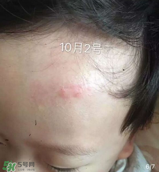 日本msd祛疤膏是抗生素嗎？日本msd祛疤膏是不是抗生素？