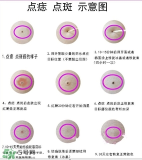 藥水點痣和激光點痣哪個好？各有什么優(yōu)缺點