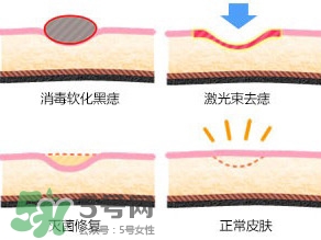 藥水點痣和激光點痣哪個好？各有什么優(yōu)缺點