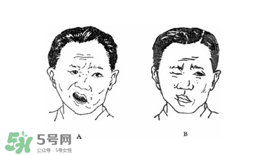 面癱是什么導(dǎo)致的？面癱多久徹底恢復(fù)正常
