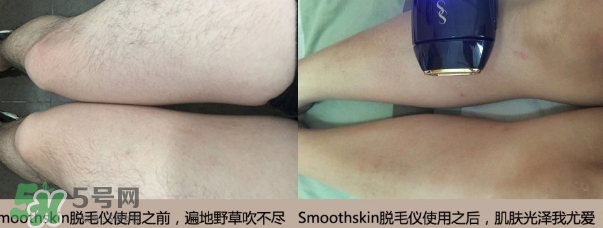 smoothskin和slikn infinity哪個(gè)好？smoothskin脫毛儀怎么樣