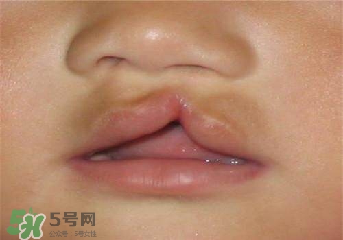 兔唇能檢查出來嗎？兔唇能完全修復(fù)嗎？